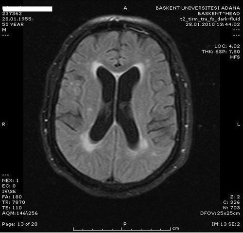 Figure 1. Axial FLAIR-weighted MRI shows chronic ischemic gliotic lesion in bilateral periventricular white matter and centrum semiovale.