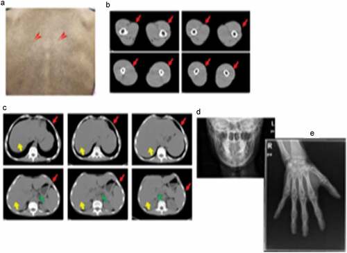 Figure 1. Clinical characteristics of laminopathy in this patient.