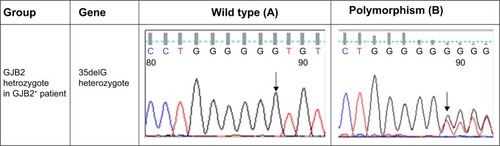 Figure 1 Comparison of sequence analysis of the polymorphism in MT-RNR1 and MT-ND1 and heterozygous GJB2 genes among patients with GJB2 mutation (GJB2+) and without GJB2 mutation (GJB2−).