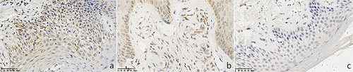 Figure 1 Expressions of CD2AP in chronic eczema lesions and the perilesional normal skin at the edge (SP *400). (a) Epidermic of skin lesion. (b) Dermis of skin lesion. (c) Perilesional normal skin. (a) More CD2AP+ monocyte-like cells with brown cytoplasm were observed in the epidermal of chronic eczema lesions. (b) More CD2AP+ monocyte-like cells with brown cytoplasm were observed in the dermal papillary layer of chronic eczema lesion. (c) Almost no of CD2AP+ monocyte-like cells with brown cytoplasm were observed in both epidermal and papillary layer of perilesional normal skin of the lesion.