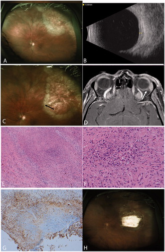 FIGURE 1. (A) Fundus photography demonstrating superotemporal area of chorioretinitis. There is a leading edge of inflammatory infiltrate with atrophy and scarring anterior to it. (B) B-scan ultrasound shows thickening of the retina and choroid. (C) Two months after her initial presentation, the area of retinitis has expanded. Note that the bifurcation of the vessels indicated by the arrow was not engulfed by the lesion in Figure 1A. (D) T1 post contrast fat-saturated MRI images demonstrate increased enhancement of the posterior sclera in the left eye (arrow). (E) Hematoxylin and eosin, 100× photomicrograph demonstrating granulomatous scleral inflammation. The lesion has a focal area of necrosis containing neutrophils surrounded by giant cells and epithelioid cells. (F) Hematoxylin and eosin, 200× photomicrograph shows focal area of necrosis with neutrophils. (G) Chromagranin diaminobenzine reaction, 100× photomicrograph stain for CD68 demonstrates positivity for histiocytes in the region surrounding the focal necrosis. (H) Postoperative fundus photography showing the healed biopsy site and no further progression of the chorioretinitis.