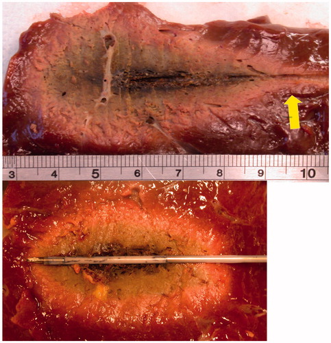 Figure 4. Microwave ablations created with 100 W for 10 min in ex vivo bovine liver. Ablations were created without the use of cooling (above) or with a prototype water-cooled antenna (below). Note the increased sphericity in the lower figure as the “tail” of the ablation (arrow) was eliminated with cooling.