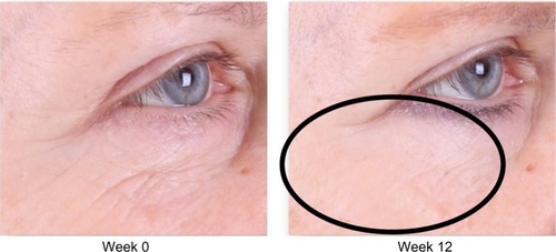 Figure 2 Improvement of crow’s feet and decrease in fine rhytides in the identified lower lid region.