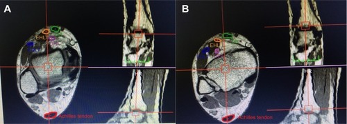 Figure 2 Center of the talus and mechanical axis were determined in T1W axial, sagittal, and coronal images by 3D software.