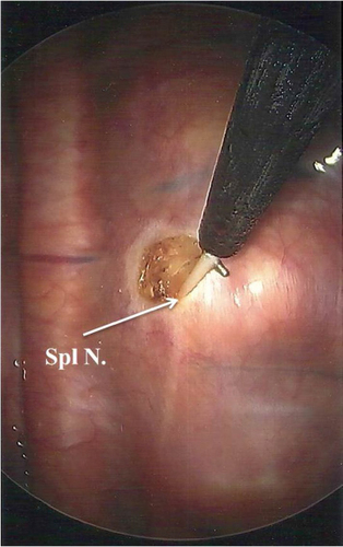 Figure 1 Thoracoscopic view of the right hemithorax with a Spl N. lifted with right angle cautery prior to neurectomy.
