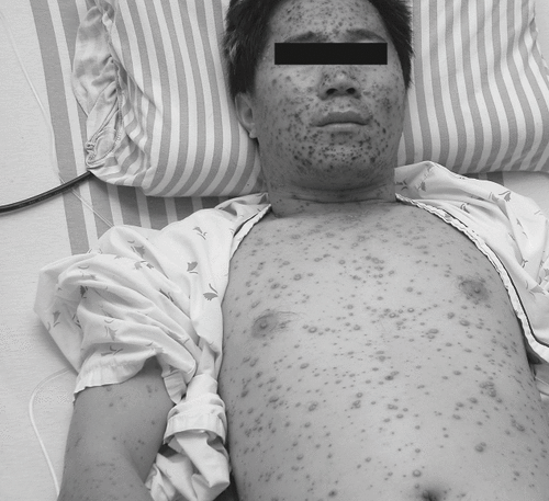 Figure 3. General vesicles and pustules over the face, trunk, and upper extremities on the seventh hospitalization day.