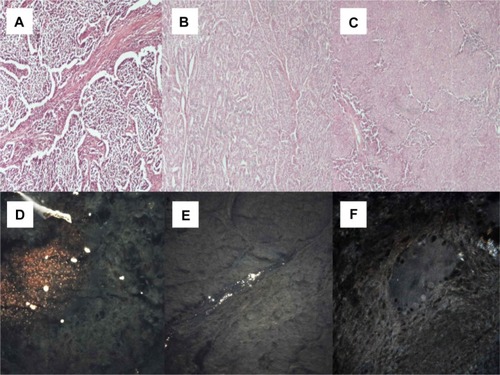 Figure 4 (A) Small cell neuroendocrine carcinoma (microscopic observation 100×). (B) Typical carcinoid tumor (microscopic observation 100×). (C) Thymoma (microscopic observation 100×). CytoViva® spectral imaging of (D) a small cell neuroendocrine carcinoma, (E) a typical carcinoid tumor, and (F) a thymoma.
