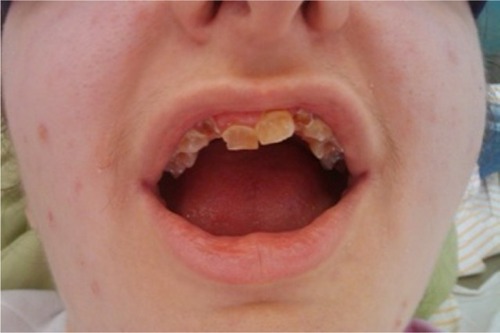 Figure 3 Dentinogenesis imperfecta with brown–yellow spots, malposition and friability.
