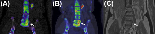 Figure 4. Coronal 99mTc-hydroxymethane diphosphonate SPECT/CT (A) 18F-NaF PET/CT (B) and T1-weighted image (C) of the same 62-year-old breast cancer patient as displayed in Figure 3. In addition to the lesions in the 5th and 7th rib on the left side detected on 99mTc-hydroxymethane diphosphonate bone scintigraphy and SPECT, lytic lesion was present in the body of the 5th lumbal vertebra (marked by white arrow).