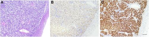 Figure 3 Immunohistochemical staining in dysgerminoma. Dysgerminoma presents with sheets of relatively uniform tumor cells with intervening thin fibrous septa and small lymphocytes (A). The tumor cells were diffusely and strongly positive for TdT (B) and confirmed by OCT4 (C) (amplification: 10×10, bar=50μm).