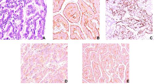 Figure 2 Pathological features of the renal carcinoid: (A) H&E (×100) showing nests and cords of neuroendocrine cells, which were arranged in a rosette like structure; (B) Positive immunostaining in tumor cells with synaptophysin (×200); (C) Intense positive immunostaining for chromogranin in tumor cells (×100); (D) Positive immunostaining in tumor cells with CD56 (×200); (E) Positive immunostaining in tumor cells with neuron specific enolase (×100).