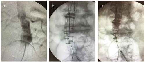 Figure 2. (a). A 52 mm abdominal aortic aneurysm with conical neck (diameters of 21.7 mm and 24 mm at 7 mm at 10 mm diameter below the lowermost renal artery, respectively). (b). Efficient sealing relies on the adjusted apposition on the conical irregularities of the neck. (c). The balloon is slightly advanced 5–7 mm cranially to inflate and facilitate accurate sealing (image courtesy of Dr. Georgakarakos).