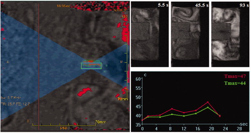 Figure 2. A typical HIFU procedure performed for sonication of a tissue-mimicking phantom containing superparamagnetic nanoparticles. Formation of a dark area around the particles container in the tissue-mimicking phantom indicated partial melting of the polymer and exposure of the magnetic core.