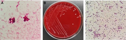 Figure 1 Colonies and microscopic morphology of Peptoniphilus asaccharolyticus. (A) Direct gram stain of the positive anaerobic bottles, 1000×. (B) Colonies on blood agar from anaerobic cultivation for 48 h. (C) Gram stain of the colonies on blood agar, 1000×.