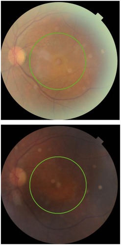 Figure 4 Fundus photography of stage 4 macular hole. Preoperatively (top) and postoperatively, after removal of silicone oil (bottom).
