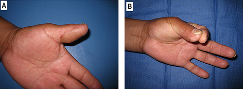 Figure 5 (A) View of the left thumb after reconstruction. (B) Restoration of pinch.