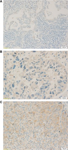 Figure 2 Three levels of RRM1 gene expression.Notes: (A) RRM1 expression of adenocarcinoma 1+. (B) RRM1 expression of adenocarcinoma 2+. (C) RRM1 expression of squamous cell carcinoma 3+.Abbreviation: RRM1, ribonucleotide reductase M1 gene.