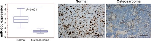 Figure 2 In situ hybridization tests showed that the relative expression level of miR-30c was significantly higher in the bone tissue than in osteosarcoma tissue (3.92±0.94 vs 1.23±0.45, P<0.001, scale bar: 100 µm, magnification: ×200), which is similar to that of qRT-PCR analysis.