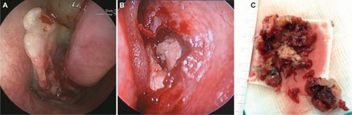 Figure 1 Clinical photography of sinonasal angiomatous polyp.