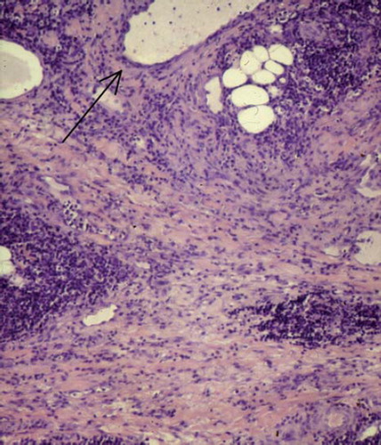 Figure 4. Section of left lung with major bronchi (H&E, × 100), showing severe broadening of lung septae with inflammation, oedema and slight fibrosis. Specimen was taken peripheral to both anastomosis and measuring site. Arrow: Small bronchus.