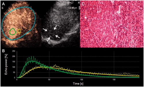 Figure 1. Representative CEUS images, time-intensity curves, and corresponding hematoxylin and eosin staining of HCC. (A) Native CEUS images show hyper-enhancement of the hypoechoic liver lesion in the arterial phase (25 s) of CEUS. Two ROIs are drawn for the following quantitative analysis: an analysis ROI (on the left) in the liver lesion and a reference ROI (on the right) in the peripheral parenchyma. (B) Output time–intensity curves of the liver lesion (curve with a higher peak value) and the reference (curve with a lower peak value). (C) Pathological result indicates well-differentiated HCC.