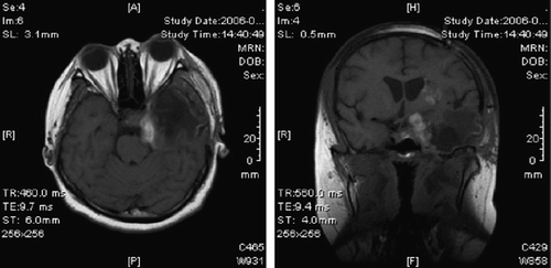 Figure 2. MRI showed the lesion was sub-total removed.