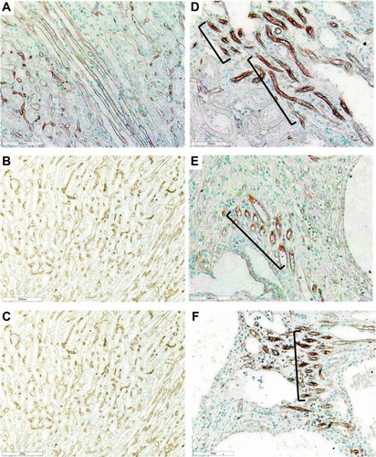 Figure 4 Photomicrographs of Lewis and LPK rats using RECA-1 immunostaining showing vascular bundles. Normal vascular bundles seen in Lewis rat at (A) week 6 (200x), (B) week 12 (200x) and (C) week 24 (200x). (D) Focal vascular bundles with dilated vessels (shown in brackets) in LPK rats at week 6 (200x). (E) Focal vascular networks (shown in brackets) in LPK rats at week 12 (200x). (F) Focal vascular bundles (shown in brackets) in LPK rats at week 24 (200x).