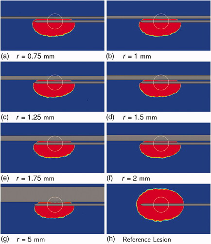 Figure 9. Tissue thermal damage at the end of the simulations for 0.75 mm ≤r≤ 5 mm. Sub-figure (h) shows the reference lesion. The tissue section containing the vessel axis and the RF-needle axis is shown. The top horizontal band in each image is the blood vessel section. Blood flow was from right to left. The bottom horizontal ‘half-band’ is the RF-needle. Blue indicates healthy tissue and red indicates ablated tissue. The white circle is the tumor boundary.
