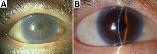 Figure 1 Slit-lamp photo before and after DMEK.
