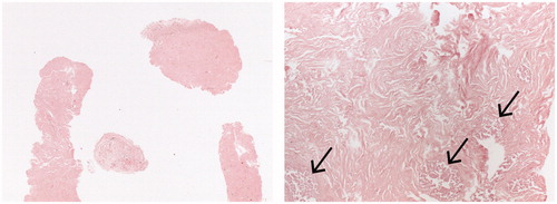 Figure 5. Low and high power view of a CNB specimen 12 months after HIFU with acellular stroma and ‘ghost glandular structures’ (arrows) as a sign of ischaemic necrosis. There was no evidence of viable lesional tissue.