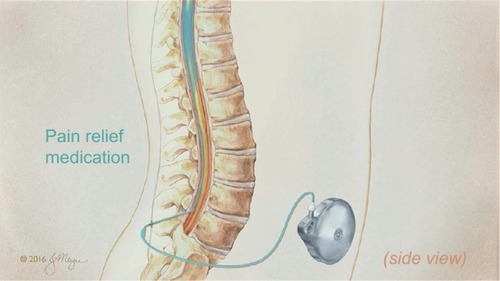 Figure 1 IT device with mechanical infusion pump and IT catheter.