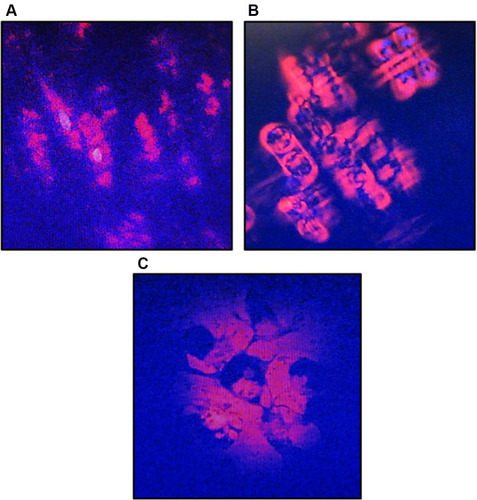 Figure 3 Morphological changes of A549 cells after treatment with CA sponges extract, detected by dual staining of Hoechst 33342 and propidium iodide (PI). (A) The untreated cells or 0 h observation, indicated structurally normal viable cells with normal nuclei. (B) After 12 h of CA sponges extract treatment, A549 cells were expected to be apoptotic as evidenced by the cell shrinkage and the separation of condensed chromatin. (C) On 24 h observation, the plasma membrane of A549 cells had lost their integrity and formed apoptotic bodies.