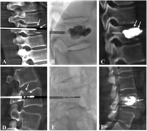 Figure 2. A 61-year-old Female patient with thoracic vertebra 10 (T10) metastases from NSCLC, and VAS score was 7 at pre-procedure (A-C). (A) the 13 G puncture needle was inserted into the T10 under the guidance of C-arm computed tomography (CT) and fluoroscopy, and intra-operative C-arm CT showed that metastases damaged the integrity of the T10 (arrow); (B) bone cement was slowly injected under real-time fluoroscopy; (C) intra-operative C-arm CT showed adequate filling of the bone cement in the T10, and the VAS score decreased to 2 at 1 week evaluation. Another 57-year-old male patient with lumbar vertebra 4 (L4) metastases from NSCLC, and VAS score was 8 at pre-procedure (D-F). (D) the 13G puncture needle was inserted into the L4 under the guidance of C-arm CT and fluoroscopy, intra-operative C-arm CT showed that metastases damaged the integrity of the L10 (arrow), and a MWA applicator was inserted into the L4 by coaxial technology; (E) the location of puncture needle and applicator were confirmed by real-time fluoroscopy; (F) intra-operative C-arm CT showed adequate filling of the bone cement in the L4, and the VAS score was reduced to 2 at 1 week evaluation.