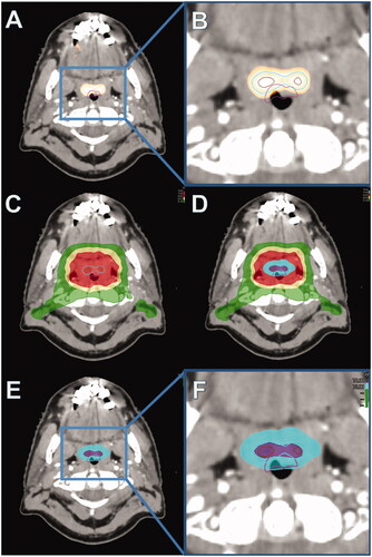 Figure 1. (A) FDG/PET CT showing the high uptake region of the primary tumor (stage T2 N0 M0, tonsillar carcinoma). (B) Delineations; Cyan = PV33, Brown = PV66, Purple = Mucosa. (C) Dose distribution of a standard plan. Green isodose = 54 Gy. Yellow isodose = 64 Gy. Red isodose = 68 Gy. (D) Dose distribution from the dose painting plan. In addition to the standard isodoses the cyan isodose = 73.1 Gy and the purple isodose = 78.2 Gy. (E) Distribution of the escalated doses, 73.1 Gy (cyan) and 78.2 Gy (purple) isodose in relation to the mucosa (pink region of interest [ROI]). (F) Zoomed in view of (E) showing the sparing of the mucosa (pink ROI).