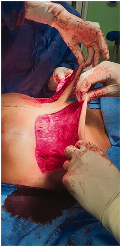 Figure 4. Intraoperative image, mastectomy and creation of dermal flaps.