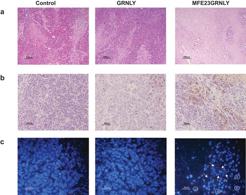 Figure 7. Histochemistry and immunohistochemistry in tissue sections of HeLa-CEA-derived tumors. (a) Representative images of H&E staining on sections form resected HeLa-CEA-derived tumors from the control group, from the granulysin-treated (GRNLY) or the MFE23GRNLY-treated groups of the experiment shown in Figure 7. (b) Tumor sections were incubated with an antibody against active caspase-3 and revealed by DAB staining. (c) Nuclei were stained using DAPI and photographed in a fluorescence microscope. Arrows indicate apoptotic, fragmented nuclei and circles indicate marginated chromatin nuclear phenotype.
