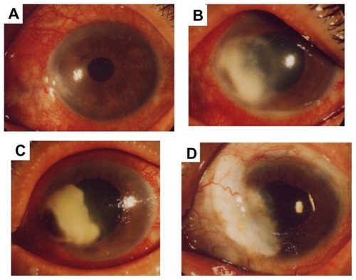 Figure 2 Case 2. (A) Nasal scleral hyperemia and nasal peripheral corneal infiltrate with feathery margins. (B) Enlargement of the corneal infiltrate 2 days after discontinuing treatment with corticosteroids and starting antifungal agents. (C) Even though voriconazole decreased the size of the corneal infiltrate, the peripheral cornea is perforated. A fibrous clot was found in the anterior chamber. (D) One year after the discharge, the cornea is clear, and no recurrence of fungal infection has been reported.