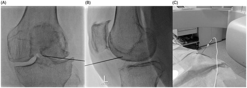 Figure 1. (A) Face fluoroscopy view of the left knee illustrating the final position of the trocar at the level of the tibial crest. (B) Lateral fluoroscopy of the left knee illustrating the final position of the trocar anteriorly to the tibial crest. (C) The RF electrode is coaxially inserted in the knee joint through the trocar and connected to the generator.