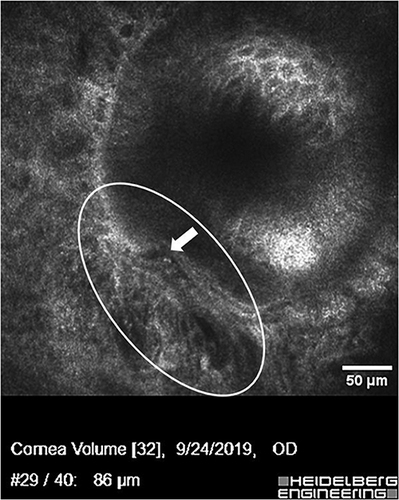 Figure 3 Confocal microscopy image of Meibomian gland distal duct showing disruption of the normally well demarcated external duct wall by fibrovascular tissue invasion. A prominent blood vessel is seen inside the oval. The disruption of the duct wall is indicated by the solid arrow showing a “step off”. This gland had not been probed. (Courtesy of SLM.).