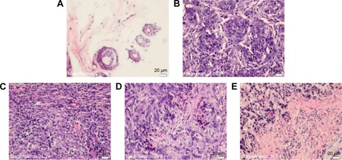 Figure 4 Histological examination of breast cancer tissue.