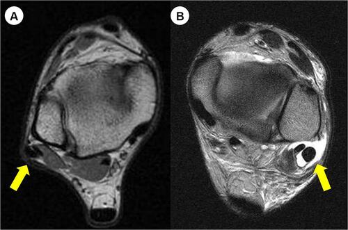 Figure 7 (A and B) Peroneal tendon subluxation and tenosynovitis in patients with chronic ankle instability.