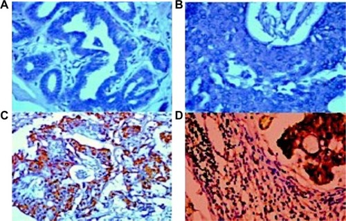 Figure 3 Representative microphotographs of immunohistochemical analysis of chemerin antigen expression in human normal breast tissue and breast cancer tissue.
