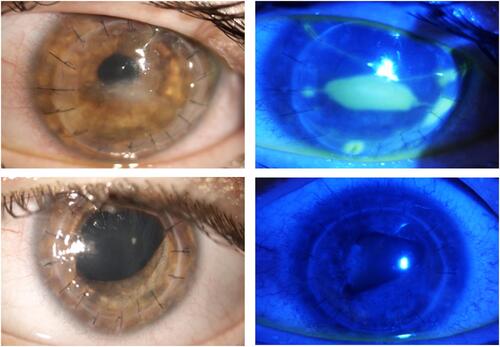 Figure 2 Ocular surface findings following cenegermin treatment for NK on PK. Slit-lamp examination showing full closure of the corneal ulcer after rh-NGF treatment with some residual stromal scarring (top left). One week after treatment discontinuation a second NK recurrence was observed (top right), that required a repeated AMT and PK approach. A second course of cenegermin was then initiated in the immediate postoperative days to prevent further NK recurrences. The treatment cycle was successfully completed as the patient presented with an intact epithelium and a transparent graft at the end of treatment (bottom left) and at the 12-months follow-up visit (bottom right).