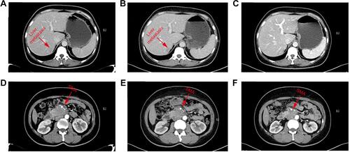 Figure 4 The result of CT-abdomen during the process of treatment. (A and D) The CT-abdomen result on April 15, 2019; (B and E) The CT-abdomen result on May 10, 2019; (C and F) The CT-abdomen result on July 26, 2019.