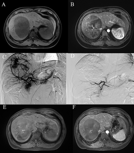 Figure 2 A 31-year-old male underwent M-TACE treatment. (A and B) The t1-weighted unenhanced magnetic resonance imaging (MRI) and t1-weighted enhanced MRI revealed a large enhancing tumor measuring 12.40 cm in the right lobe before M-TACE. (C and D) The hepatic angiography conducted before and after the M-TACE procedure revealed complete devascularization of the tumor’s tumor-feeding arteries. (E and F) Follow up t1-weighted unenhanced MRI and t1-weighted enhanced MRI at 1 month revealed complete response of the tumor.
