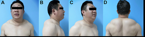 Figure 2 A 46-year-old male patient with subcutaneous adipose masses distributed at submental, supraclavicular, and dorsal areas ((A) the front side, (B and C) the right side, (D) the dorsal side). He had no obvious symptoms except cosmetic abnormalities. He was also alcoholic and had combinations with hypertension, diabetes, and hepatic cirrhosis. He experienced disease recurrence 13.2 months after surgical interventions of the dorsal lipomatous masses.