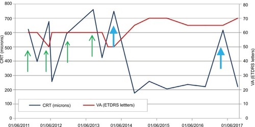 Figure 1 VA and CRT over time following treatment with repeated injections of the DEX (n=4) and FAc implant (n=2).