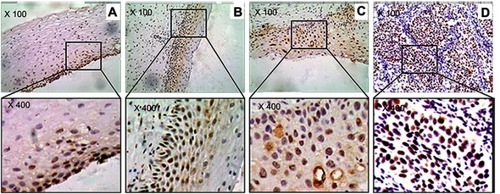 Figure 3 The marker (Chk2) of DNA damage response in study sample. (A) Cervicitis; (B) CIN I; (C) CIN II/III; (D) SCC. Original magnification, ×100 and ×400.