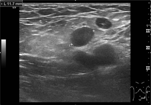 Figure 1 An inguinal ultrasound examination showed subcutaneous edema and numerous benign reactive enlarged lymph nodes.