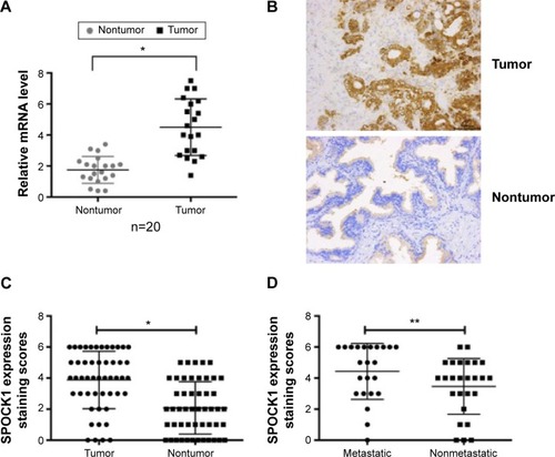 Figure 1 SPOCK1 is overexpressed in prostate cancer tissues.